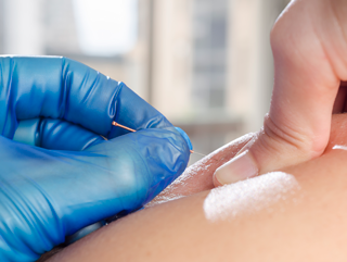 Person receiving a dry needling proceedure